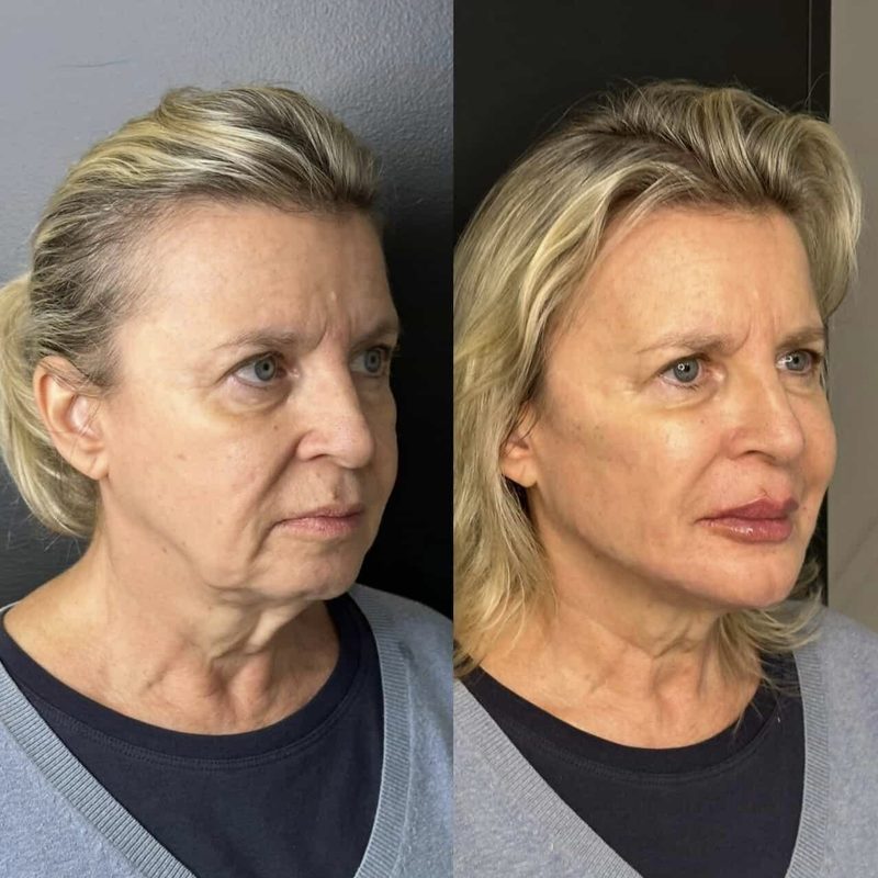 Caso 4 — antes e depois do FULLFACE